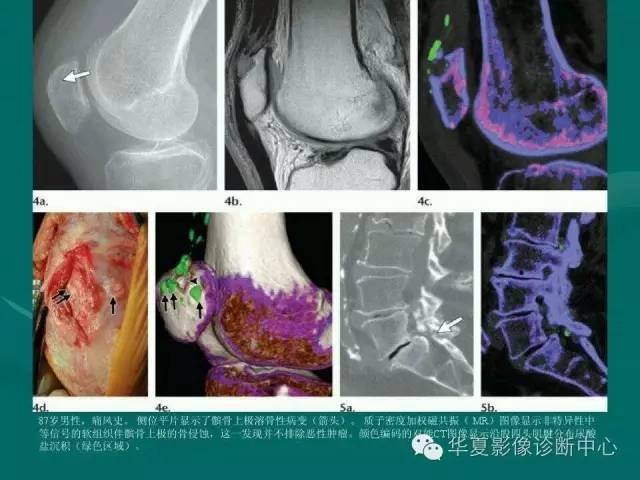 【病例】如此痛风，您认识吗？
