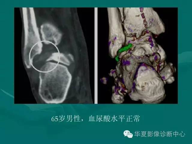 【病例】如此痛风，您认识吗？
