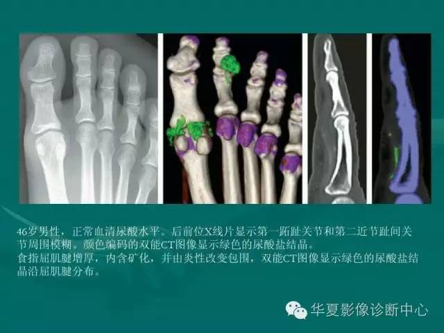 【病例】如此痛风，您认识吗？