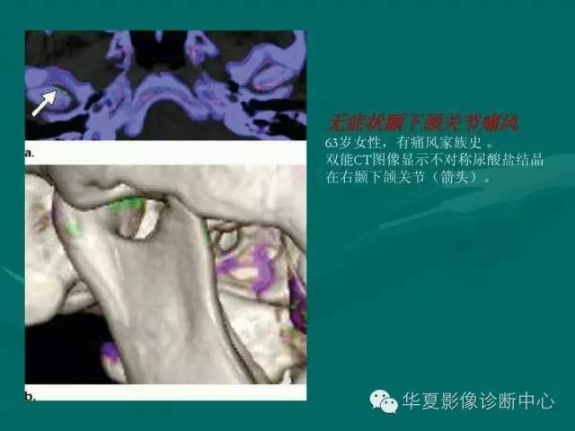 【病例】如此痛风，您认识吗？
