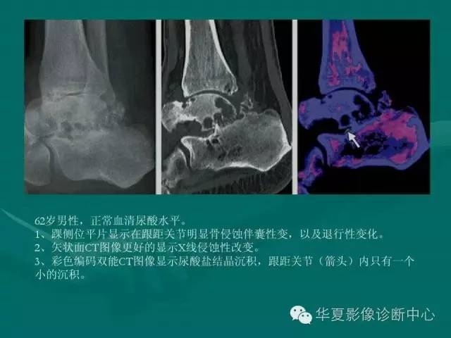 【病例】如此痛风，您认识吗？