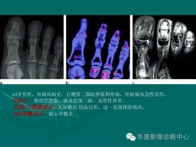 【病例】如此痛风，您认识吗？