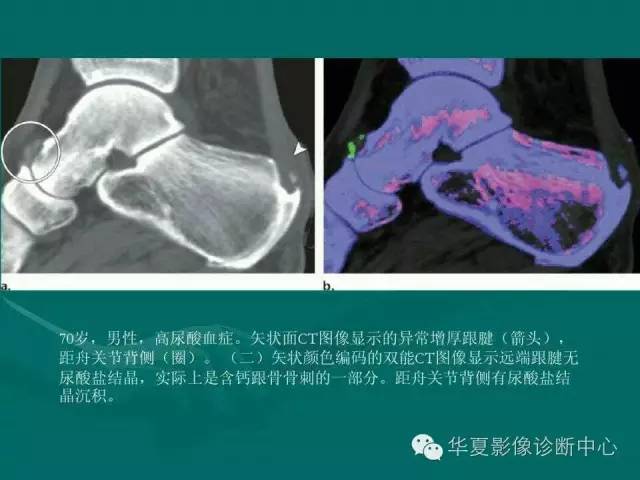 【病例】如此痛风，您认识吗？