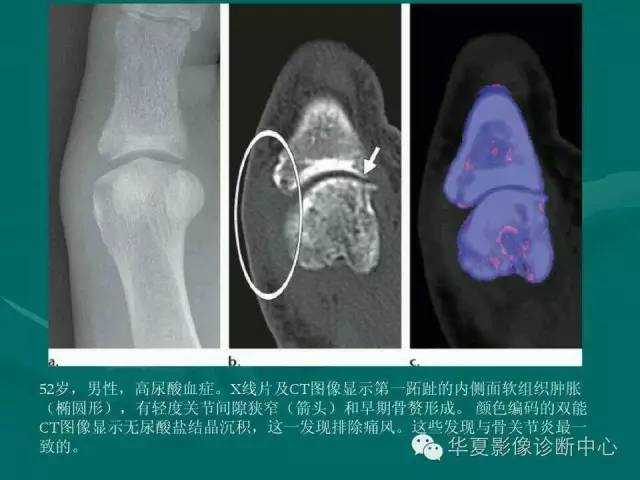 【病例】如此痛风，您认识吗？