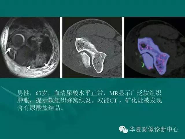【病例】如此痛风，您认识吗？