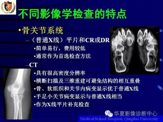 【PPT】痛风影像学检查及诊断