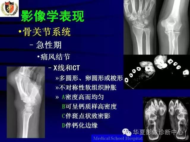 【PPT】痛风影像学检查及诊断