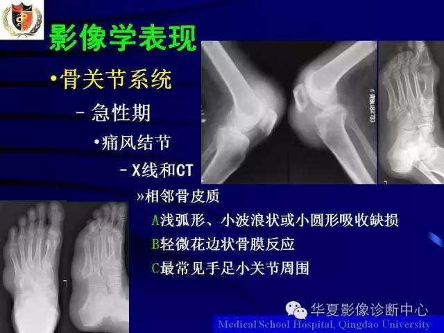 【PPT】痛风影像学检查及诊断