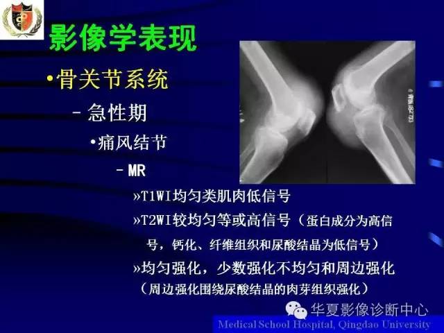 【PPT】痛风影像学检查及诊断