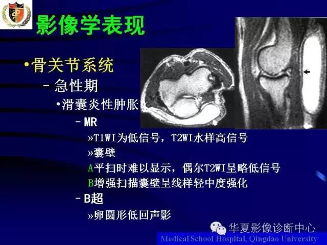 【PPT】痛风影像学检查及诊断