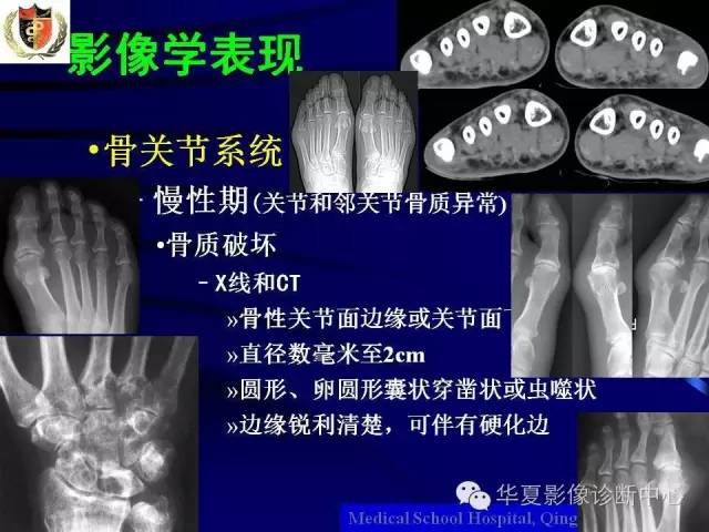 【PPT】痛风影像学检查及诊断
