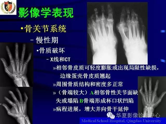 【PPT】痛风影像学检查及诊断