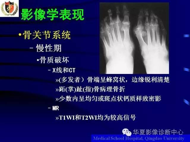 【PPT】痛风影像学检查及诊断