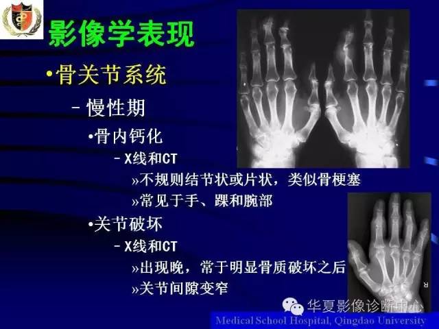 【PPT】痛风影像学检查及诊断