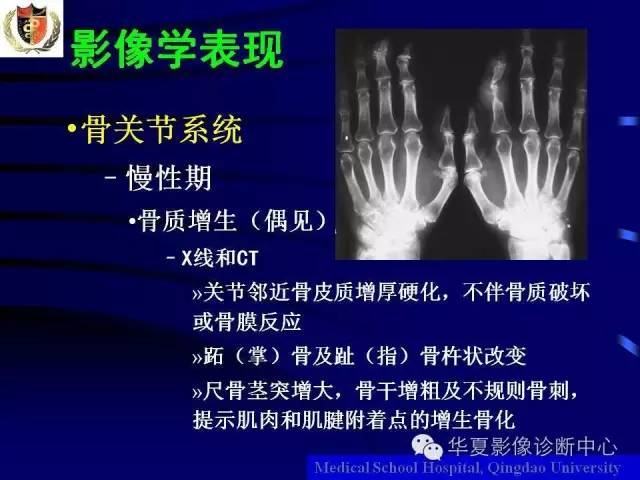 【PPT】痛风影像学检查及诊断