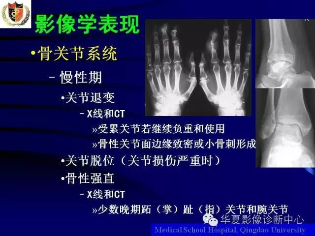【PPT】痛风影像学检查及诊断