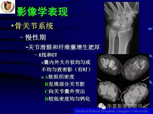 【PPT】痛风影像学检查及诊断