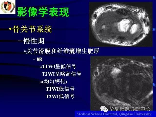 【PPT】痛风影像学检查及诊断