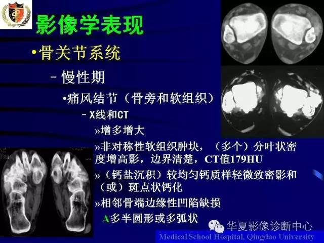 【PPT】痛风影像学检查及诊断
