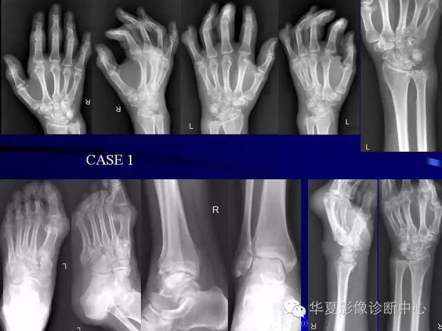 【PPT】痛风影像学检查及诊断