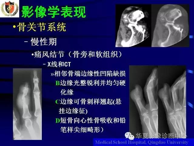 【PPT】痛风影像学检查及诊断