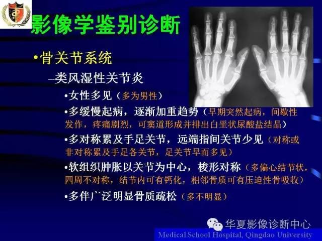 【PPT】痛风影像学检查及诊断