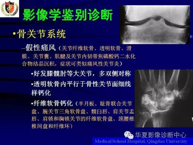 【PPT】痛风影像学检查及诊断