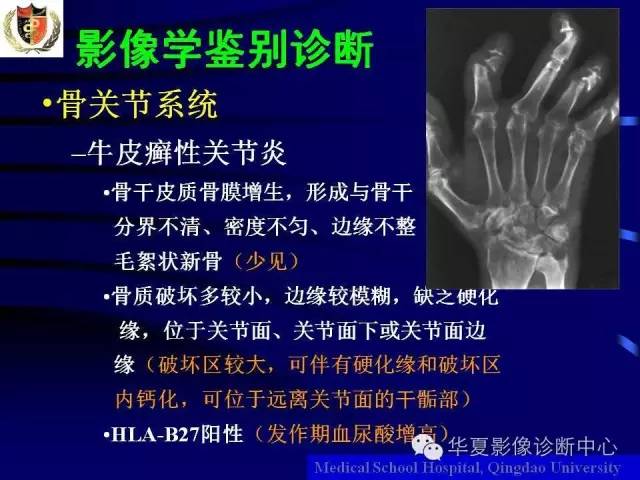 【PPT】痛风影像学检查及诊断