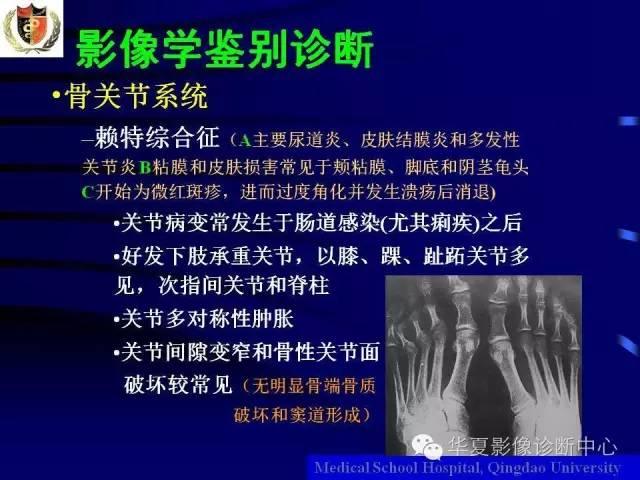 【PPT】痛风影像学检查及诊断