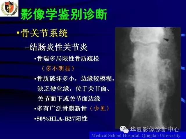 【PPT】痛风影像学检查及诊断