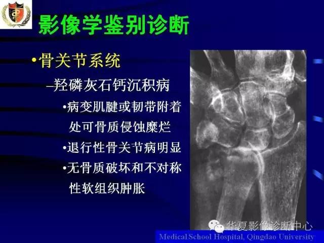 【PPT】痛风影像学检查及诊断