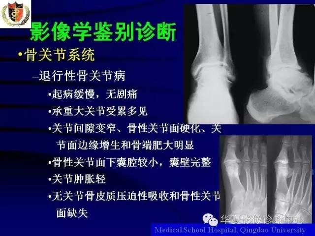 【PPT】痛风影像学检查及诊断