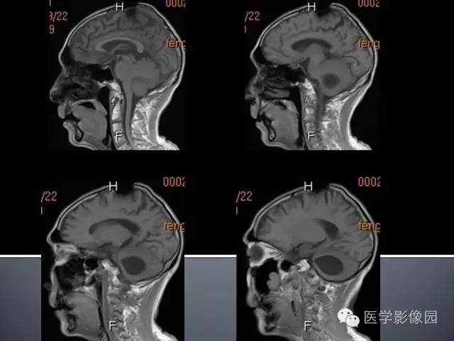 【病例】小脑囊性转移瘤1例MR影像表现