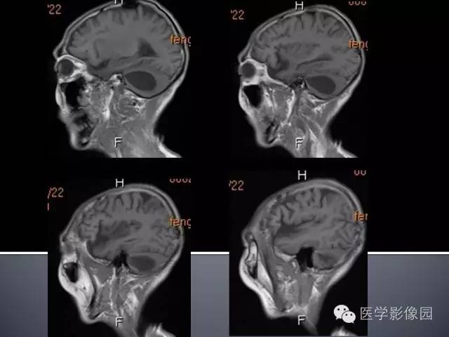 【病例】小脑囊性转移瘤1例MR影像表现