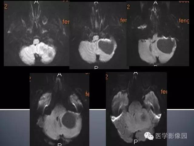 【病例】小脑囊性转移瘤1例MR影像表现