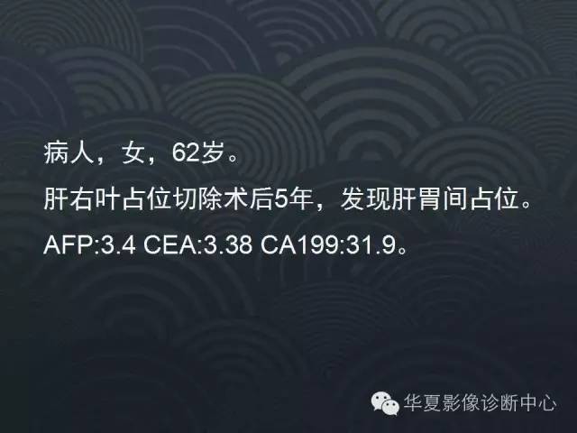 【病例】腹膜后神经鞘瘤1例CT影像表现