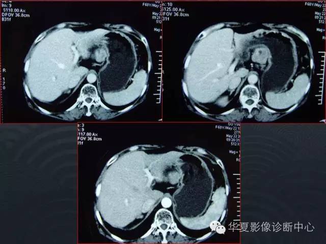 【病例】腹膜后神经鞘瘤1例CT影像表现