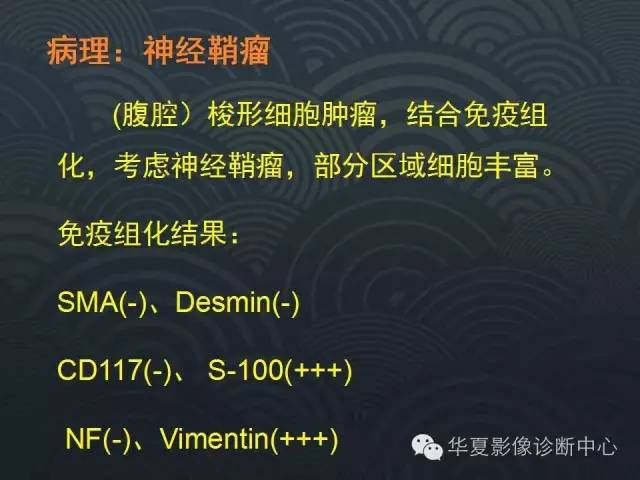 【病例】腹膜后神经鞘瘤1例CT影像表现