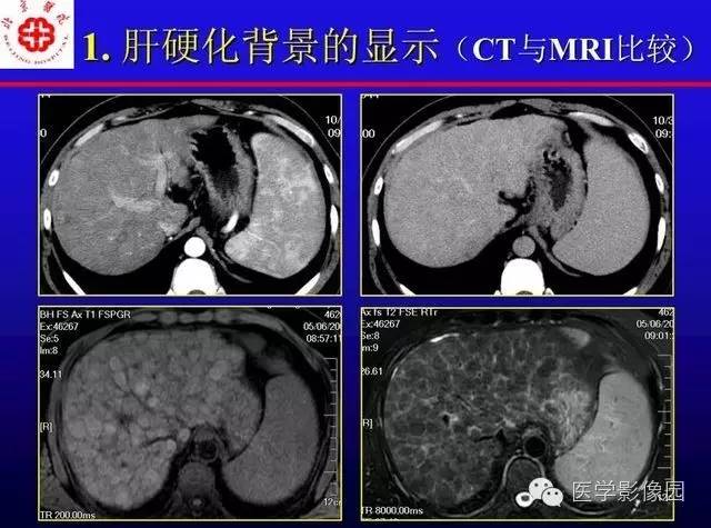 【PPT】MRI在腹部实质脏器病变诊断中的优势