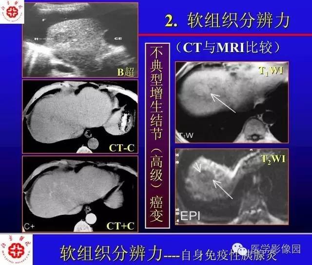 【PPT】MRI在腹部实质脏器病变诊断中的优势