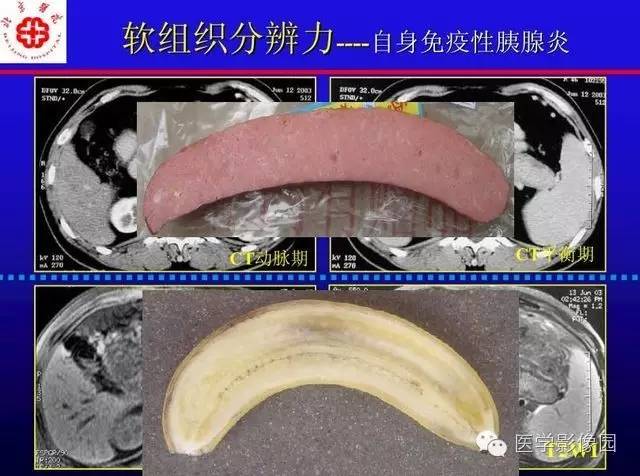 【PPT】MRI在腹部实质脏器病变诊断中的优势