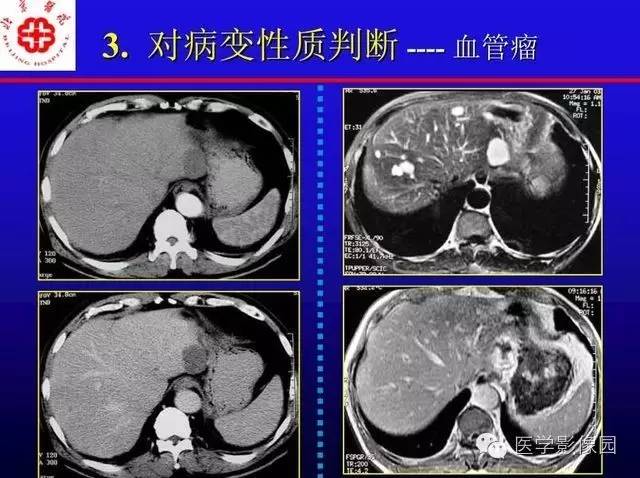 【PPT】MRI在腹部实质脏器病变诊断中的优势