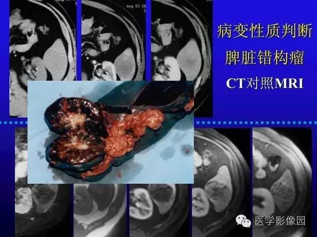 【PPT】MRI在腹部实质脏器病变诊断中的优势