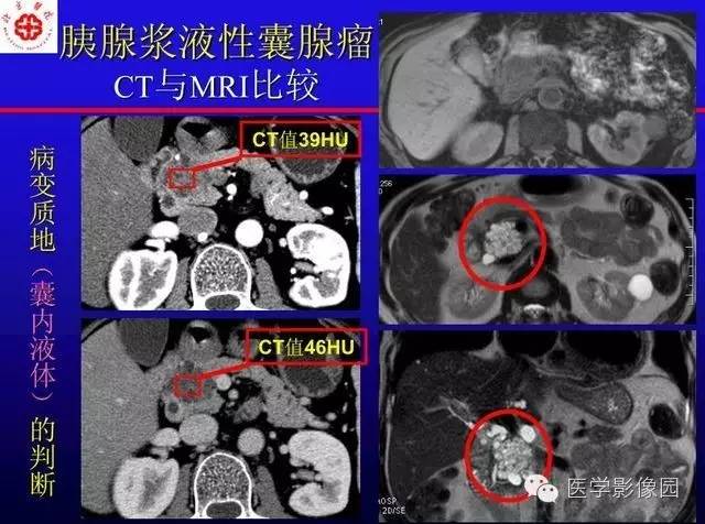 【PPT】MRI在腹部实质脏器病变诊断中的优势
