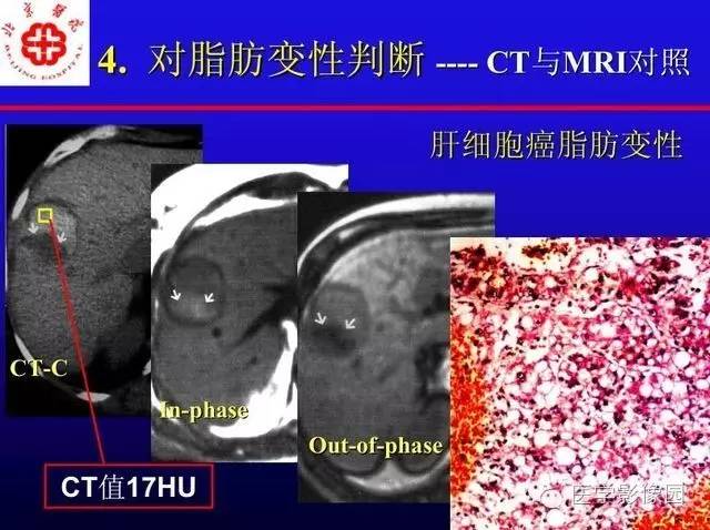 【PPT】MRI在腹部实质脏器病变诊断中的优势
