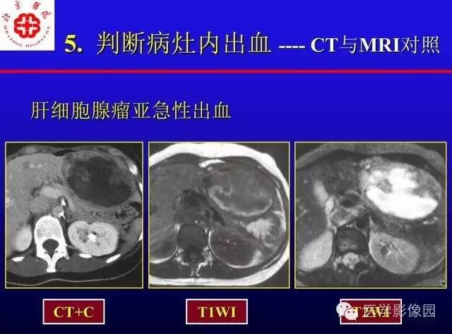 【PPT】MRI在腹部实质脏器病变诊断中的优势