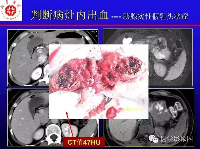 【PPT】MRI在腹部实质脏器病变诊断中的优势