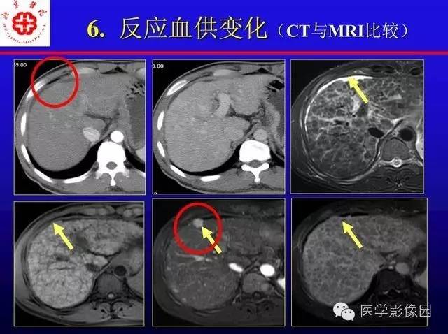 【PPT】MRI在腹部实质脏器病变诊断中的优势