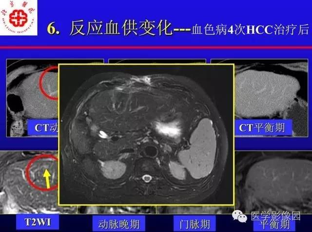 【PPT】MRI在腹部实质脏器病变诊断中的优势