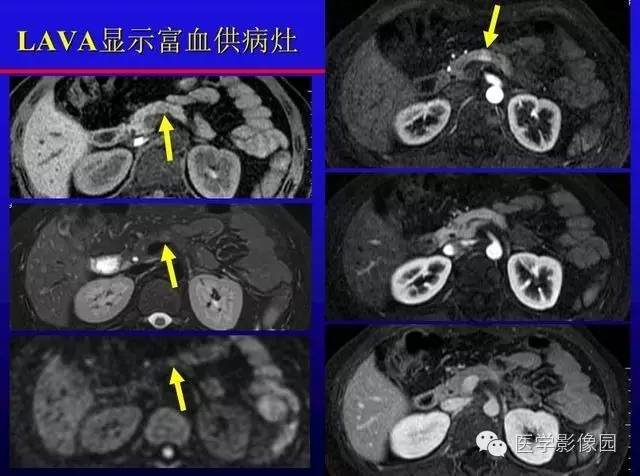 【PPT】MRI在腹部实质脏器病变诊断中的优势